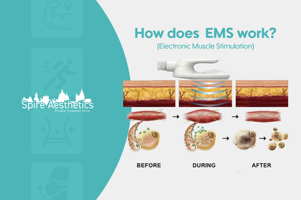 EMS treatment for post pregnancy weight loss treatment Edgware