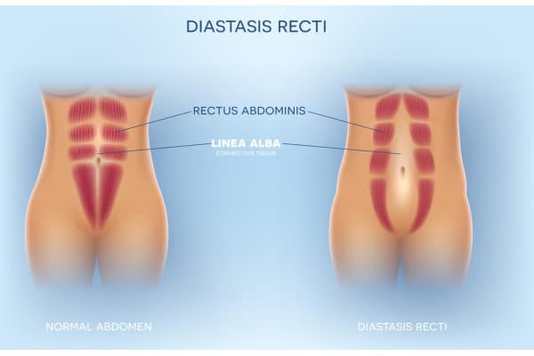 What Non-Surgical Options Are Available for Diastasis Recti Edgware?