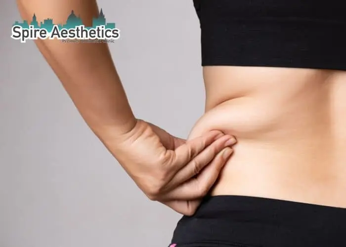 Image of woman pinching fat on their hips Edgware. Fat Freezing treatment