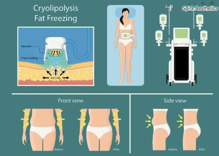 Fat freezing treatment Edgware benefits for competitions to remove stubborn fat deposits.
