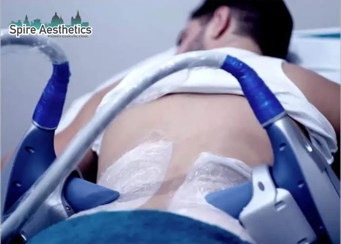 Man having fat freezing treatment done on love handles before a competitions Edgware to create a sculpted look.