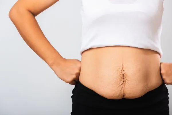 Image of a woman's stomach after weight loss with sagging skin following a gastric band Edgware