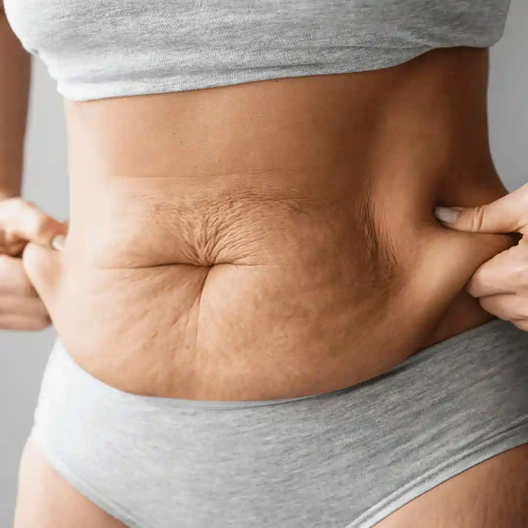Is It Normal to Have Loose Skin After Pregnancy Edgware?