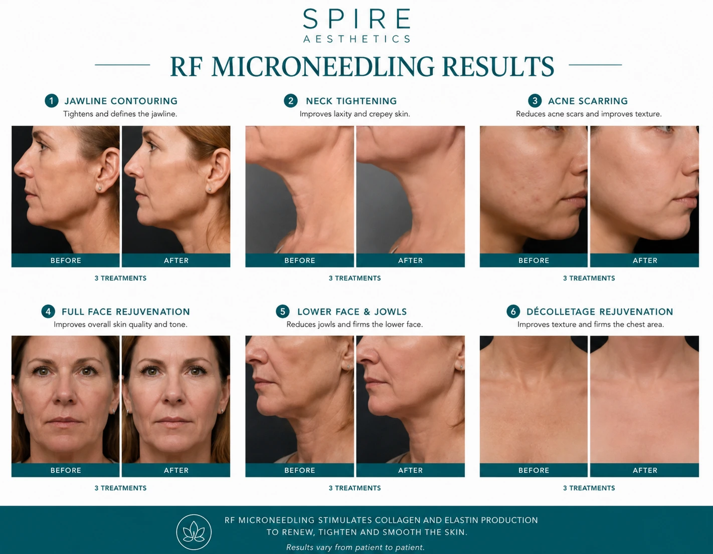 RF Microneedling Skin tightening Edgware results