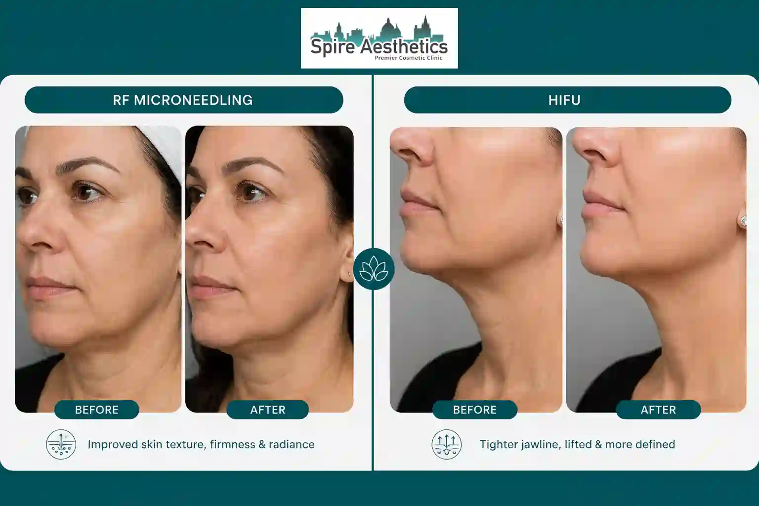 Can RF Microneedling and HIFU Be Combined Edgware?