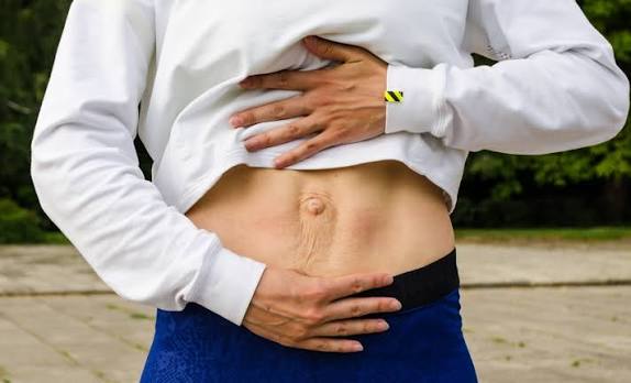When Could Diastasis Recti Be the Missing Piece of the Puzzle Edgware?